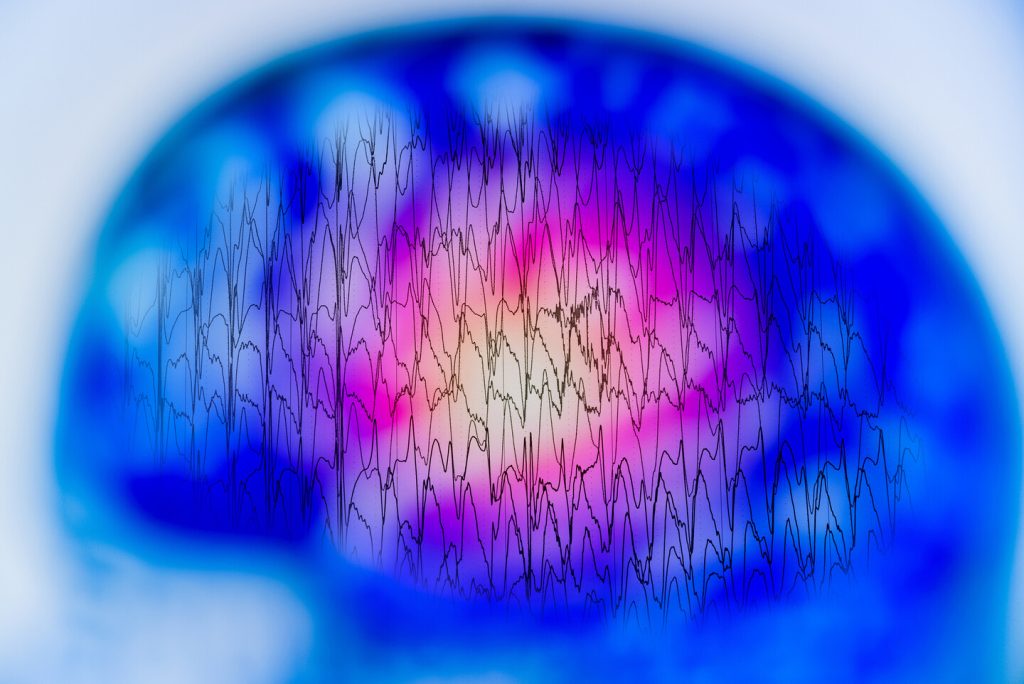 EEG with electrical activity of abnormal brain, electroencephalogram, EEG